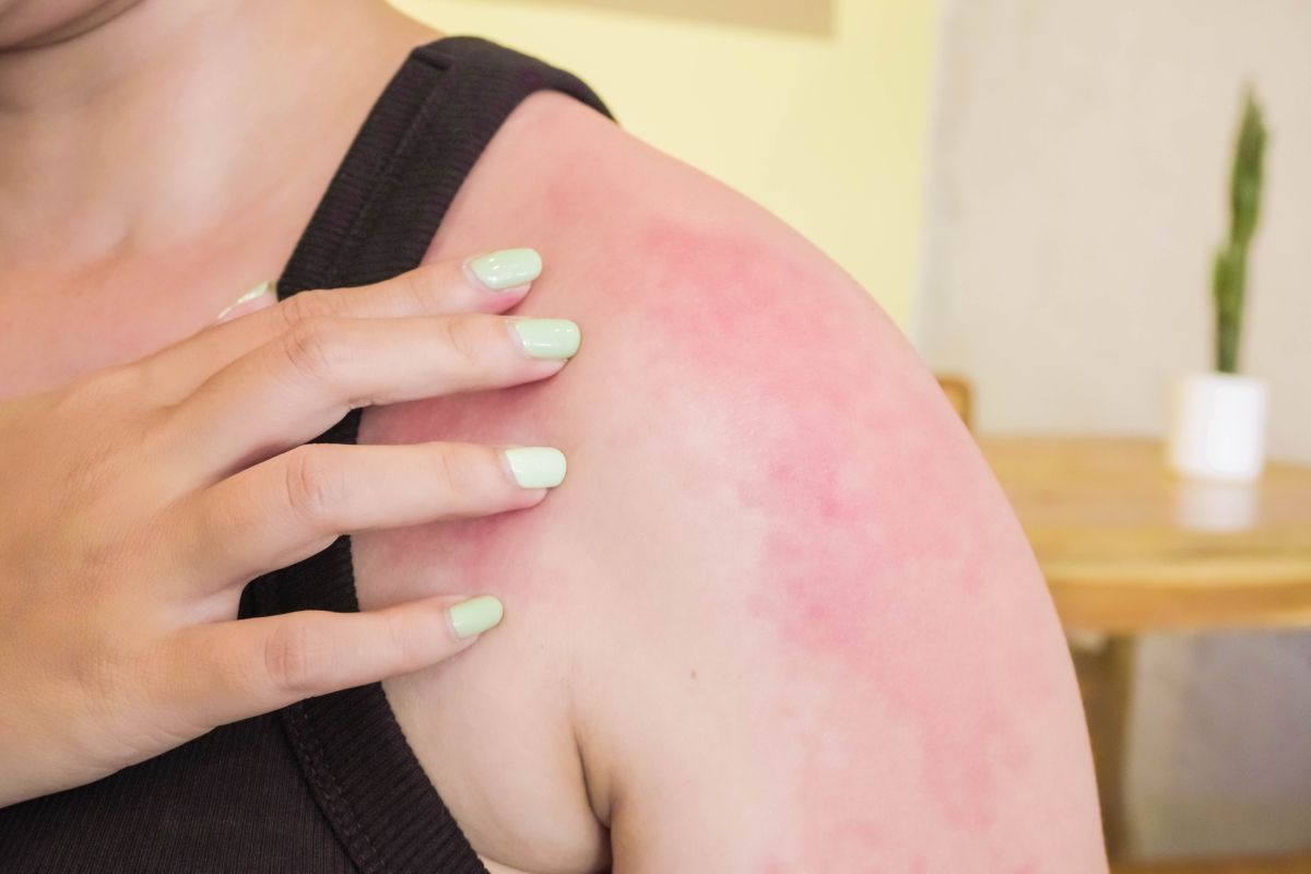 Allergia al nichel: sintomi e alimenti da evitare per una dieta senza rischi - immagine di copertina