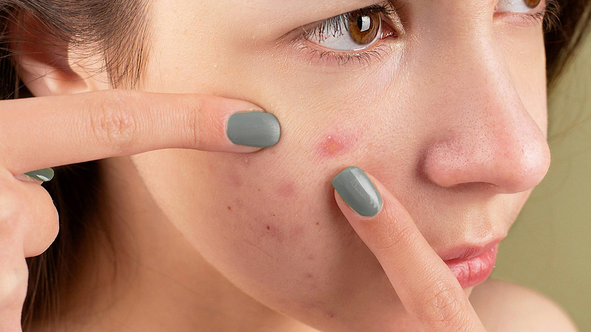 Acne: come regolare il sebo con i rimedi naturali - immagine di copertina