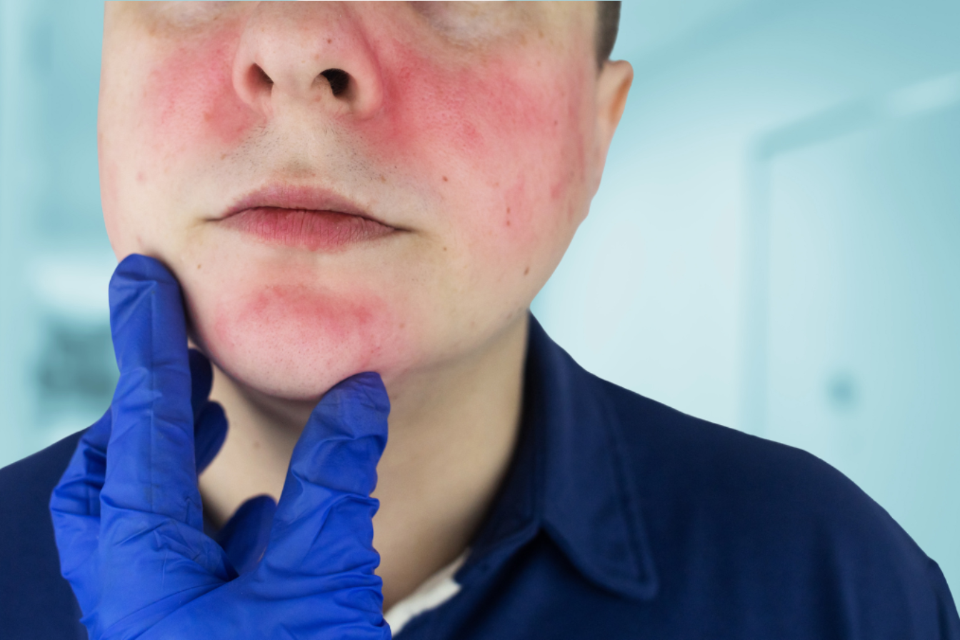 lupus
