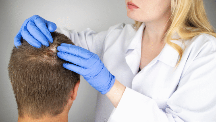 Alopecia: imparare a riconoscere i tipi e i segnali precoci - immagine di copertina